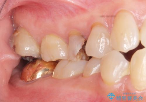 虫歯による歯の喪失　ジルコニアブリッジの製作の治療前