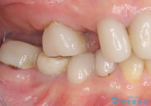 歯の欠損を放置 オールセラミックブリッジによる補綴治療の治療前