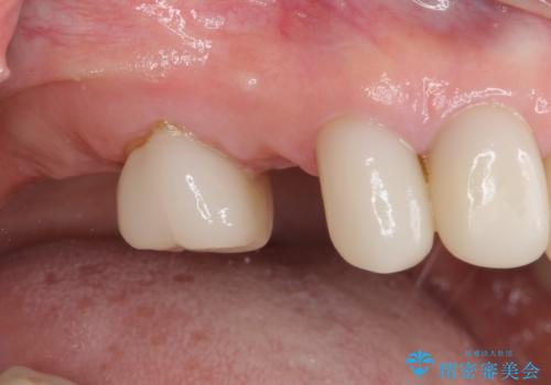 歯の欠損を放置 オールセラミックブリッジによる補綴治療の治療前