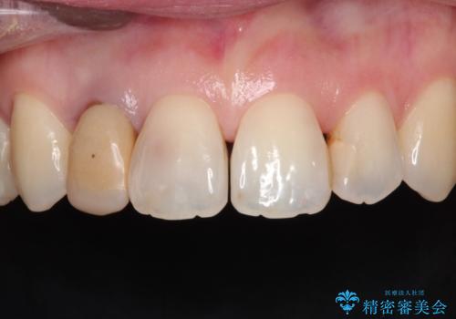 前歯が痛い。根管治療~オールセラミッククラウンの症例 治療前