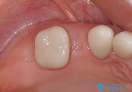 歯の欠損を放置 オールセラミックブリッジによる補綴治療の治療前