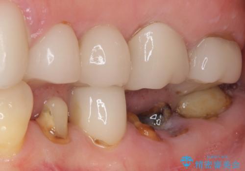 歯の欠損を放置　オールセラミックブリッジによる補綴治療の症例 治療前