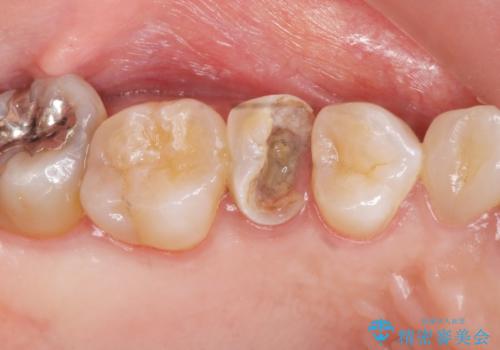 虫歯による歯の喪失　ジルコニアブリッジの製作の治療前