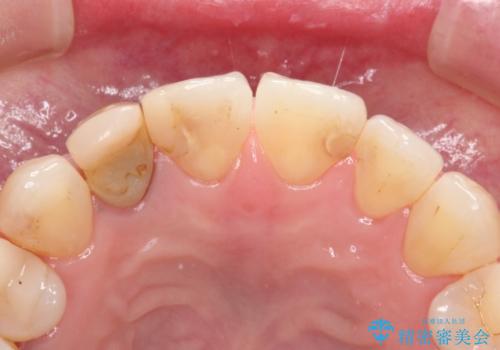 前歯が痛い。根管治療~オールセラミッククラウンの治療前