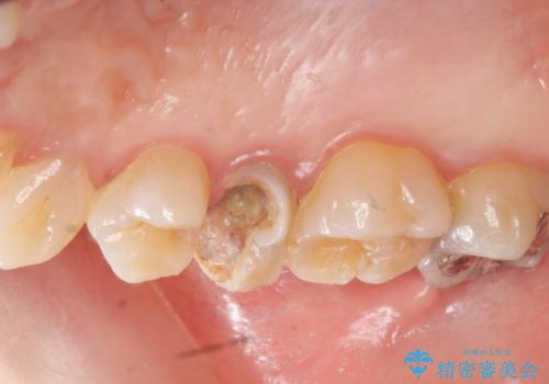 虫歯による歯の喪失　ジルコニアブリッジの製作の症例 治療前