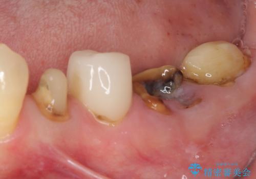 歯の欠損を放置 オールセラミックブリッジによる補綴治療の治療前