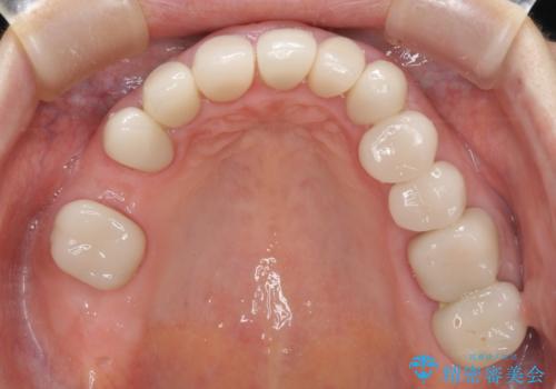 歯の欠損を放置 オールセラミックブリッジによる補綴治療の治療前