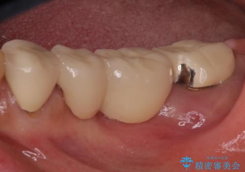 奥歯が痛くて噛めない　インプラントによる補綴治療の治療前