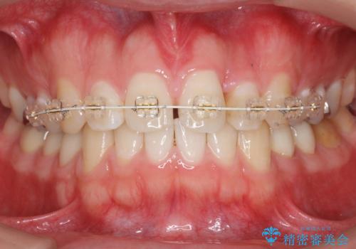 前歯のねじれ 上だけ部分矯正でコストダウンの治療中