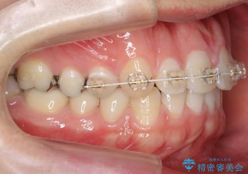 前歯のねじれ 上だけ部分矯正でコストダウンの治療中