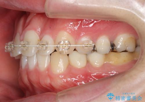 前歯のねじれ 上だけ部分矯正でコストダウンの治療中