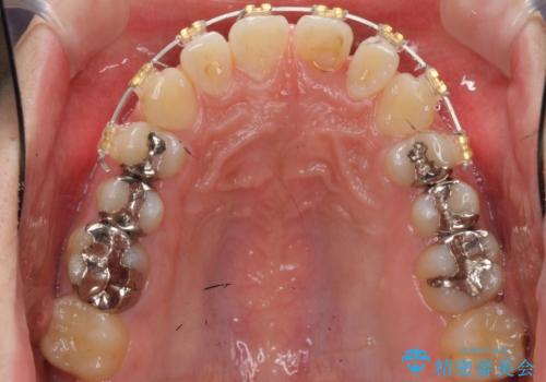 前歯のねじれ 上だけ部分矯正でコストダウンの治療中