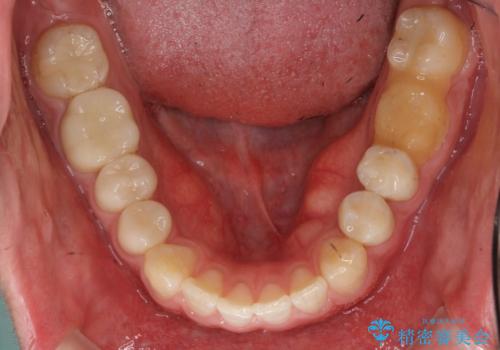 前歯のねじれ 上だけ部分矯正でコストダウンの治療中