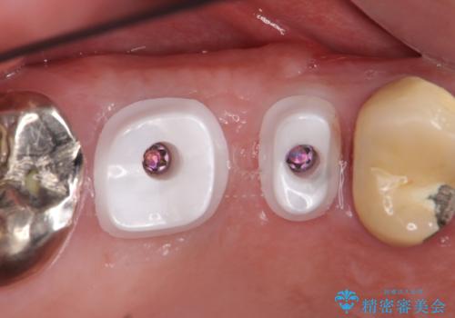 インプラント(ストローマン) 抜歯後の欠損補綴の治療中