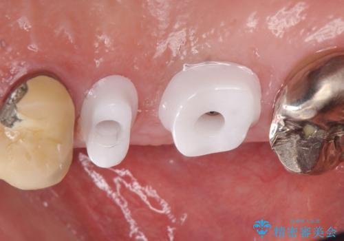 インプラント(ストローマン) 抜歯後の欠損補綴の治療中