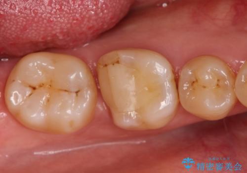 奥歯が痛い。根管治療~オールセラミッククラウンの治療前