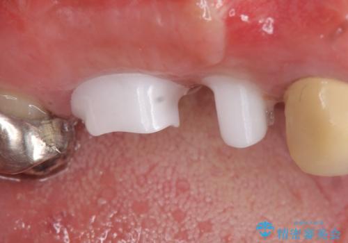インプラント(ストローマン)　抜歯後の欠損補綴の治療中