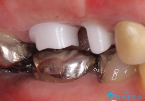 インプラント(ストローマン) 抜歯後の欠損補綴の治療中