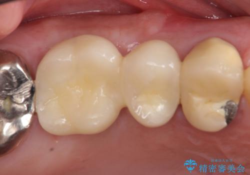 インプラント(ストローマン)　抜歯後の欠損補綴の症例 治療後