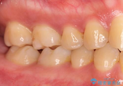 奥歯が痛い。根管治療~オールセラミッククラウンの治療前