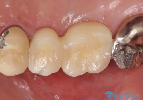 インプラント(ストローマン) 抜歯後の欠損補綴の治療後