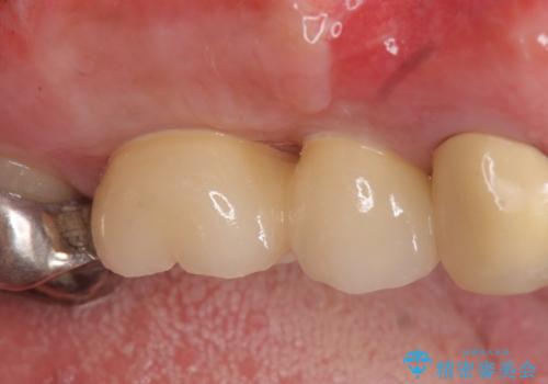 インプラント(ストローマン) 抜歯後の欠損補綴の治療後