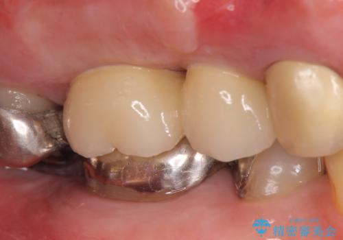 インプラント(ストローマン) 抜歯後の欠損補綴の治療後