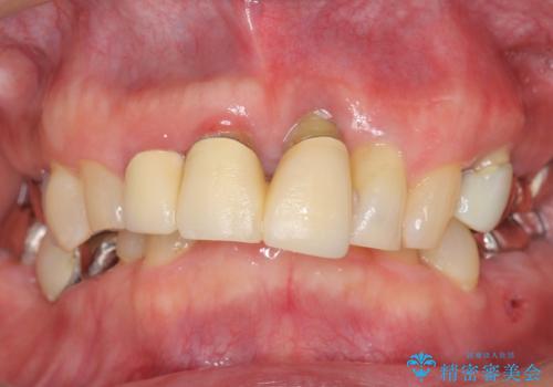 親知らずの移植 70代男性の治療前