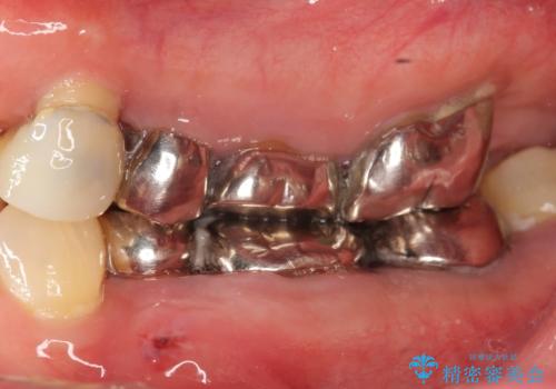 親知らずの移植 70代男性の症例 治療前