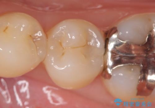 セラミックインレー 他院にて歯の神経治療が必要と言われた虫歯の治療前