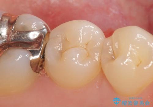 セラミックインレー 他院にて歯の神経治療が必要と言われた虫歯の治療前