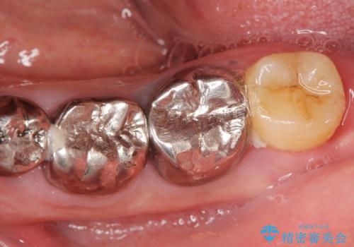 親知らずの移植 70代男性の治療前