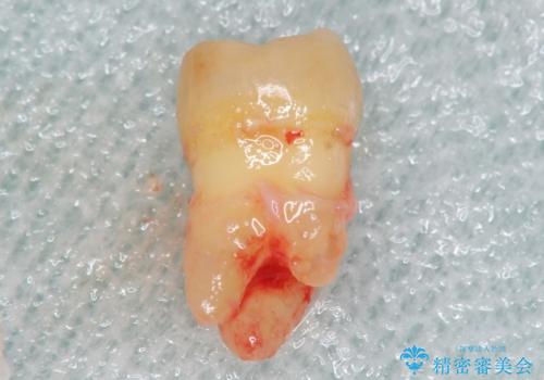 親知らずの移植 70代男性の治療中