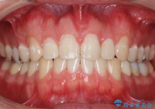 前歯のねじれ 上だけ部分矯正でコストダウンの症例 治療後