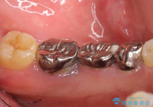 親知らずの移植 70代男性の治療前