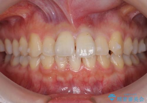 軽度の前歯のがたつき 下の前歯が生まれつき少ないの治療中