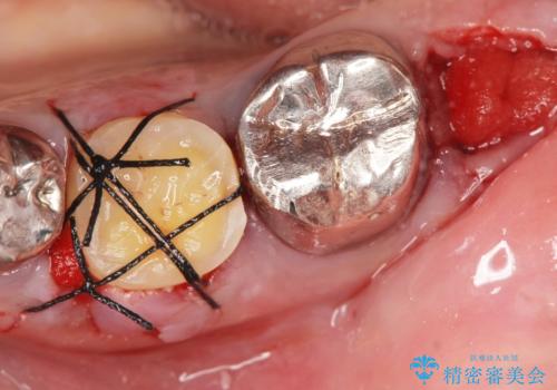 親知らずの移植 70代男性の治療中