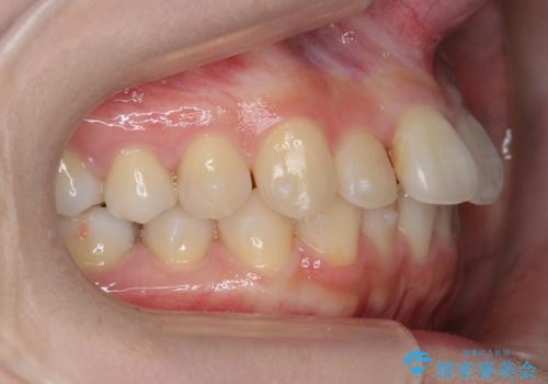 軽度の前歯のがたつき 下の前歯が生まれつき少ないの治療中