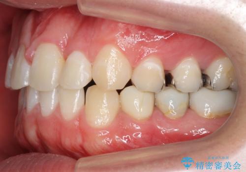 前歯のねじれ 上だけ部分矯正でコストダウンの治療後