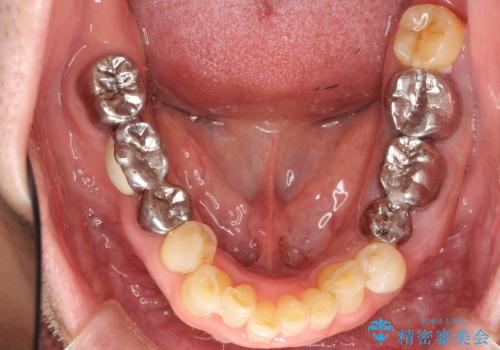 親知らずの移植 70代男性の治療前
