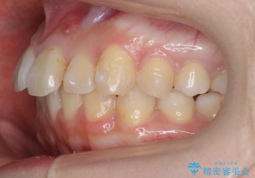 軽度の前歯のがたつき　下の前歯が生まれつき少ないの治療中