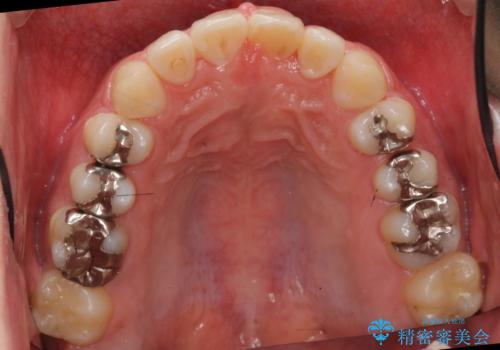前歯のねじれ 上だけ部分矯正でコストダウンの治療後