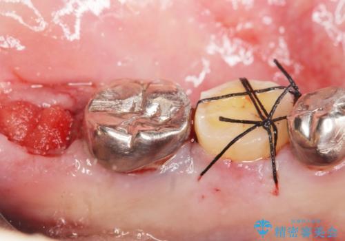 親知らずの移植 70代男性の治療中