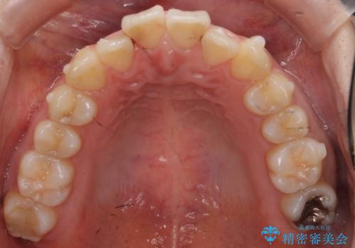 軽度の前歯のがたつき　下の前歯が生まれつき少ないの治療中