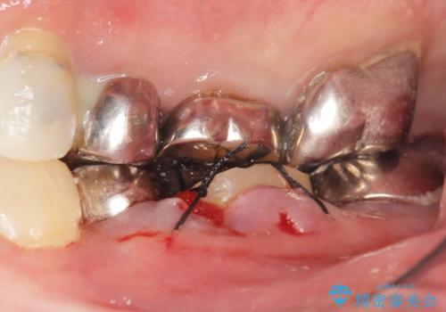 親知らずの移植 70代男性の治療中