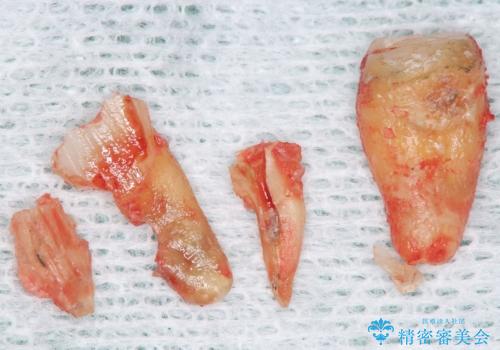 親知らずの移植 70代男性の治療中