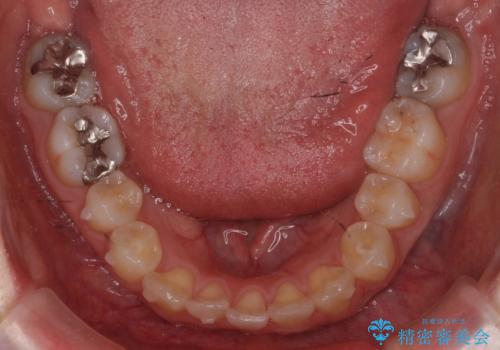 軽度の前歯のがたつき 下の前歯が生まれつき少ないの治療中