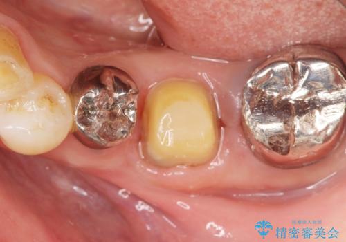 親知らずの移植 70代男性の治療後
