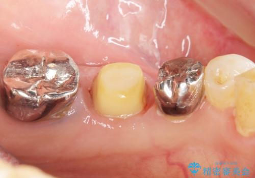 親知らずの移植 70代男性の治療中