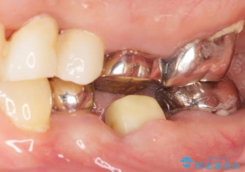 親知らずの移植 70代男性の治療前